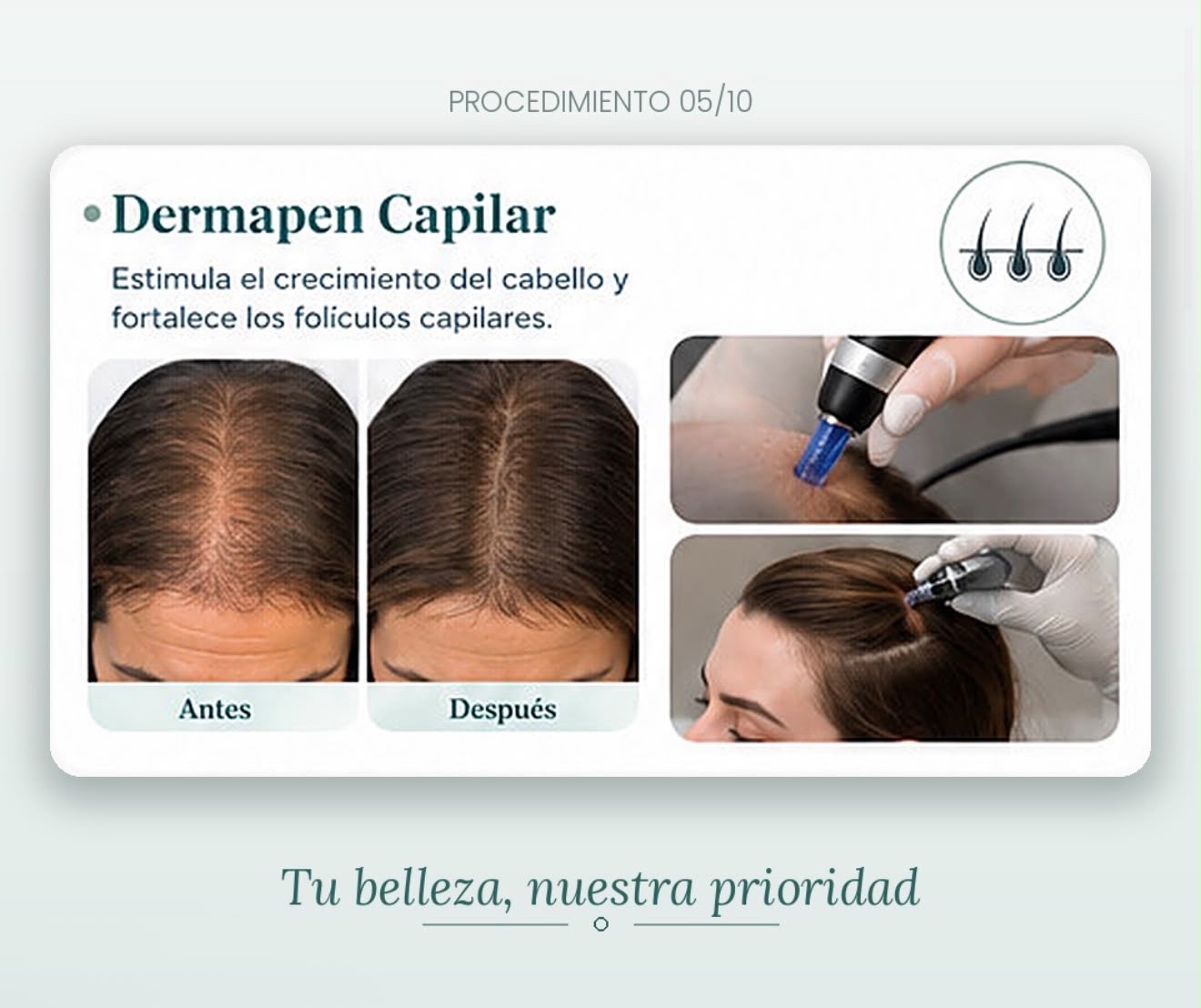 Información visual sobre el procedimiento Dermapen capilar