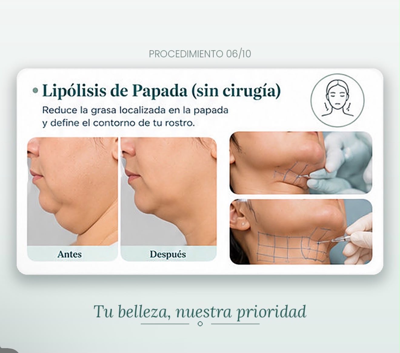 Información visual sobre la lipólisis de papada sin cirugía