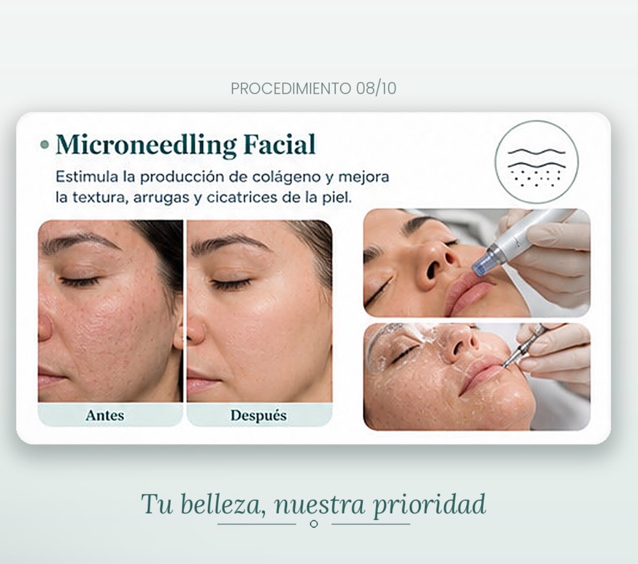 Información visual sobre el procedimiento de microneedling facial