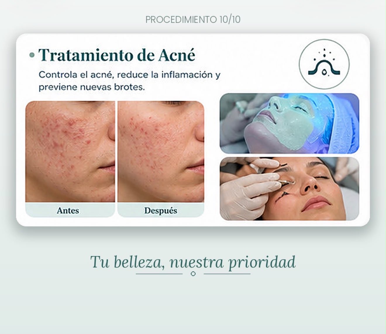 Información visual sobre el tratamiento facial para el acné